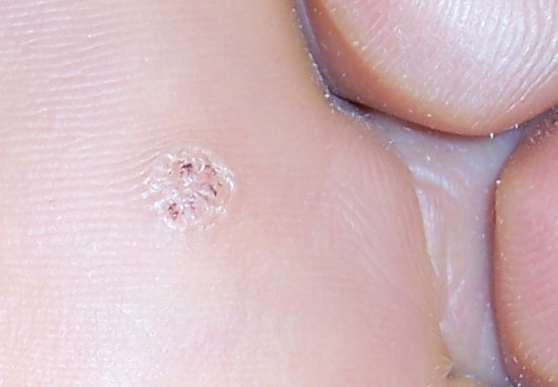 Verrucae Treatment in South Woodford