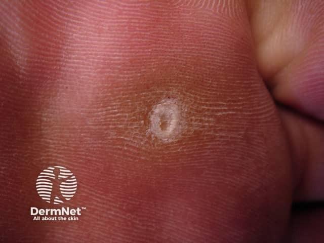 Corns, calluses and cracked heels treatment in South Woodford