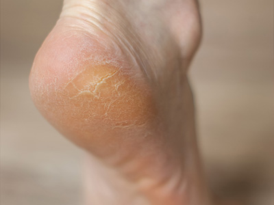 Corns, calluses and cracked heels treatment in South Woodford