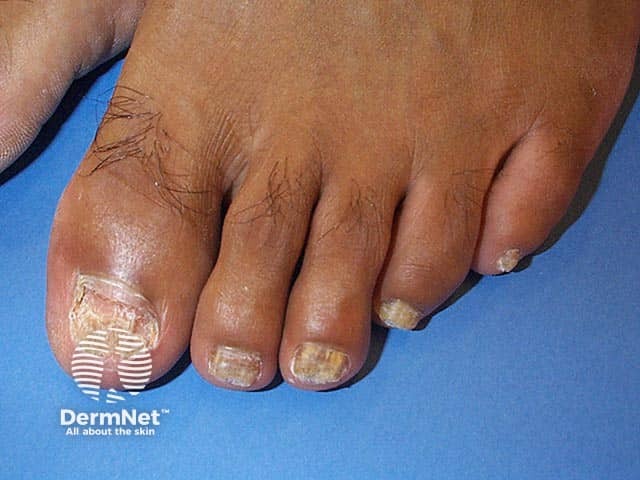Athletes Foot & Fungal Nails Treatment in South Woodford