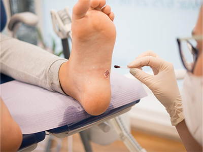 Verrucae Treatment in South Woodford