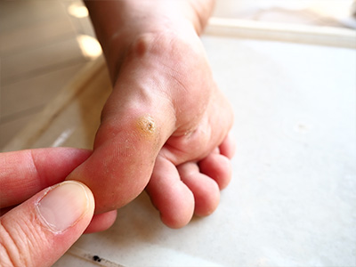 Verrucae Treatment in South Woodford